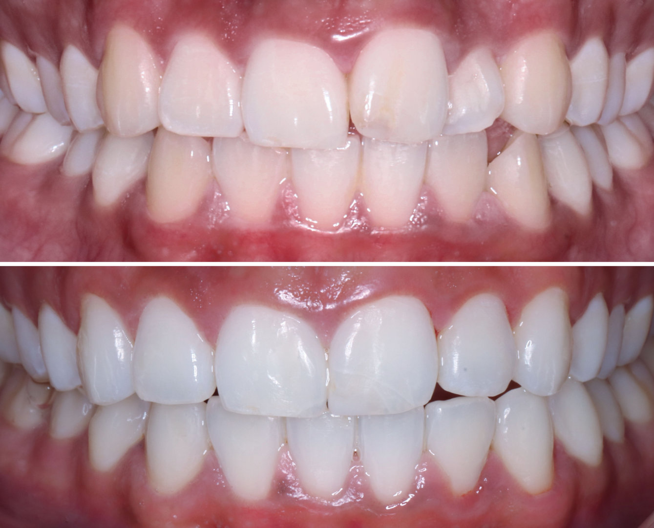 le tooth Invisalign Ascot & West End, Brisbane